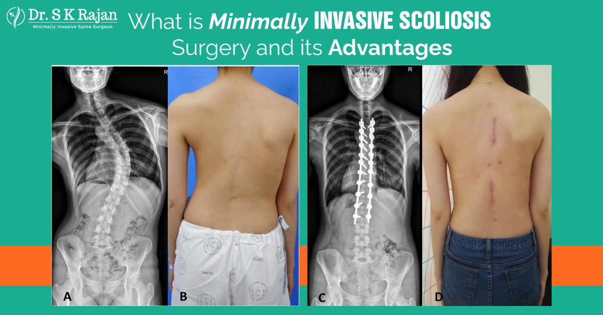Scoliosis Dian